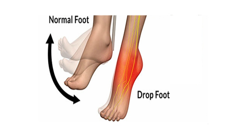 foot drop