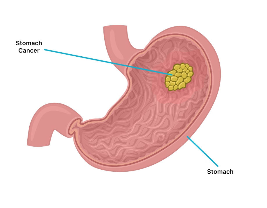 leads to stomach cancer